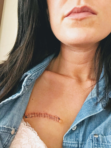 Woman with surgical scar on chest